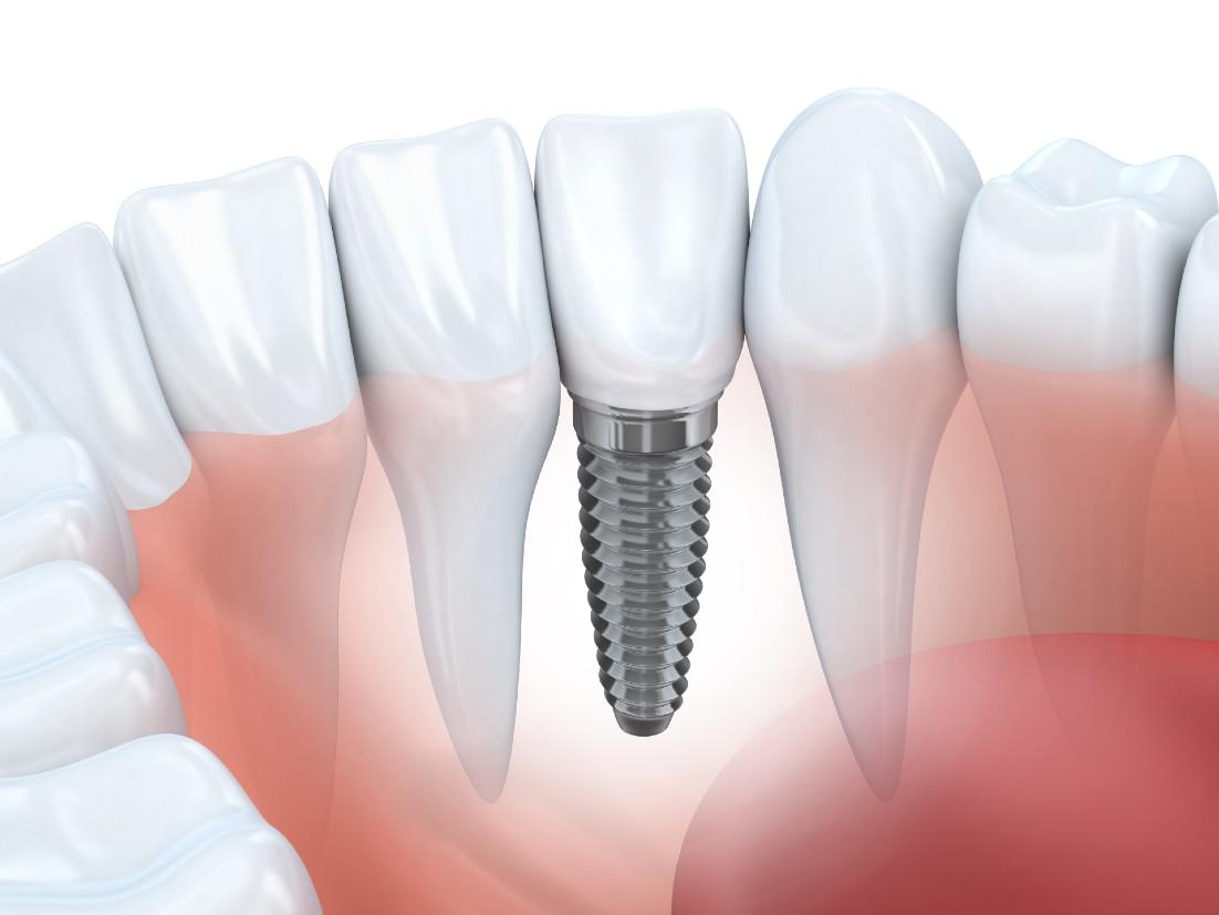 Dental Implants Westfield Center, OH